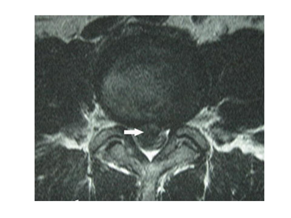 Discs In Lower Back. a lower back and radiates